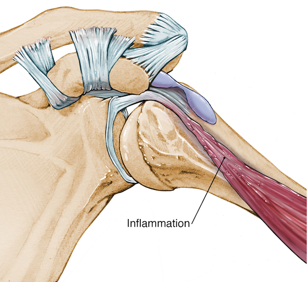 Long biceps tendonitis